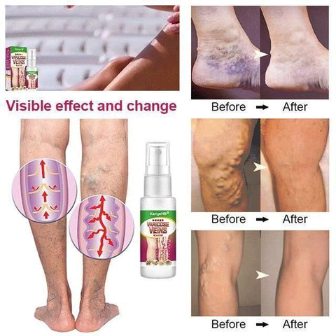 Veinhealing Varicose Veins Treatment Spray (Pack of 2)